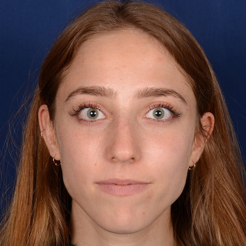 Female Rhinoplasty Before & After Gallery - Patient 146164 - Image 2