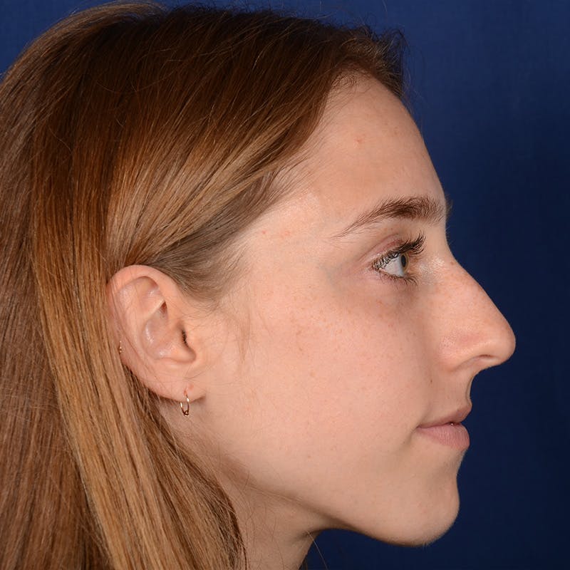 Female Rhinoplasty Before & After Gallery - Patient 146164 - Image 5