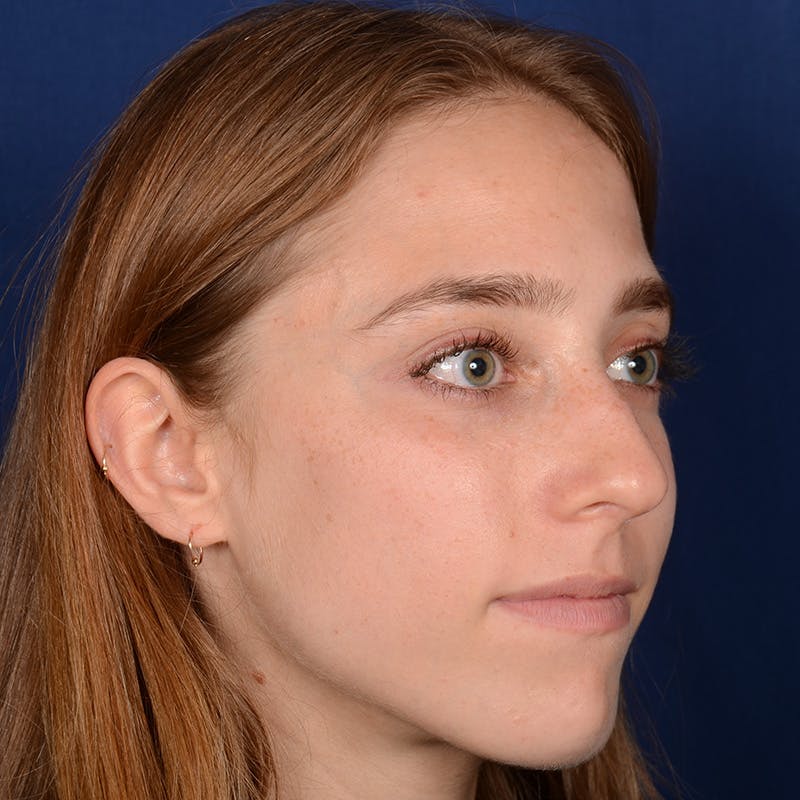 Female Rhinoplasty Before & After Gallery - Patient 146164 - Image 3
