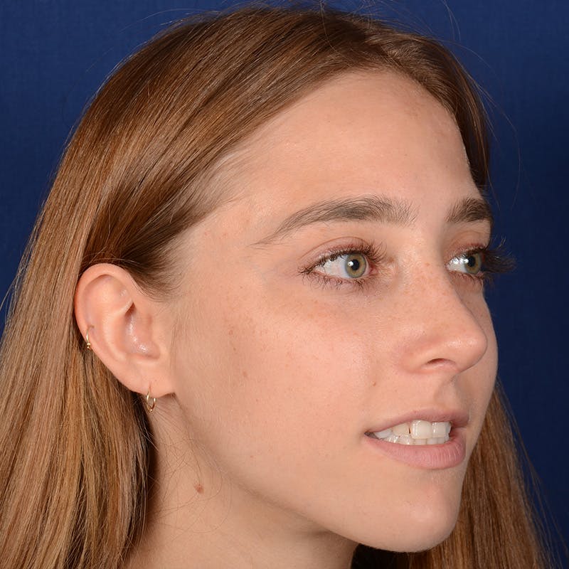 Female Rhinoplasty Before & After Gallery - Patient 146164 - Image 4