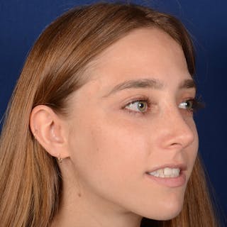 Female Rhinoplasty Before & After Gallery - Patient 146164 - Image 4