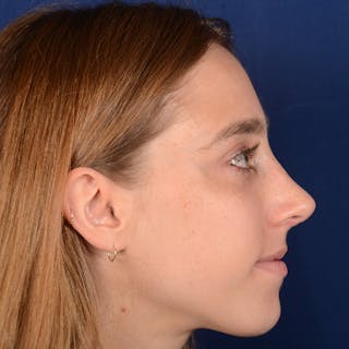 Female Rhinoplasty Before & After Gallery - Patient 146164 - Image 6