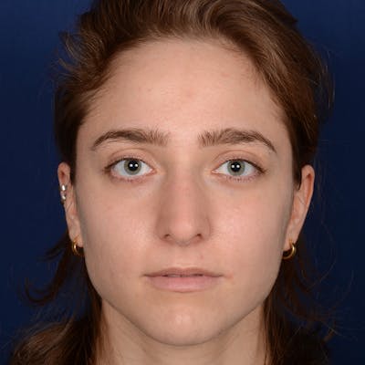 Female Rhinoplasty Before & After Gallery - Patient 196167 - Image 1
