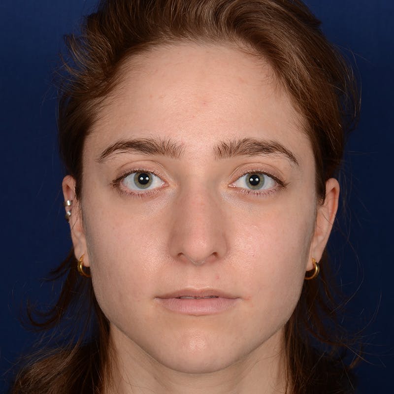 Female Rhinoplasty Before & After Gallery - Patient 196167 - Image 1