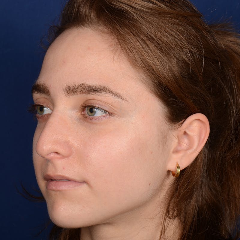 Female Rhinoplasty Before & After Gallery - Patient 196167 - Image 3