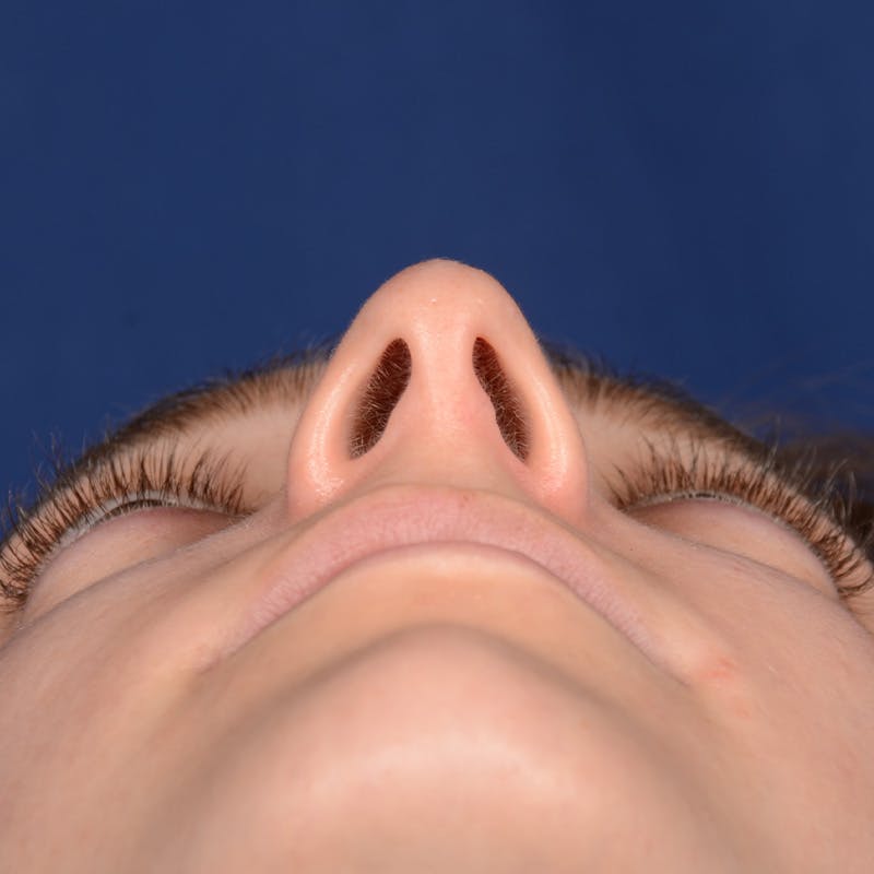 Female Rhinoplasty Before & After Gallery - Patient 196167 - Image 7
