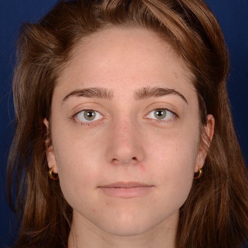 Female Rhinoplasty Before & After Gallery - Patient 196167 - Image 2