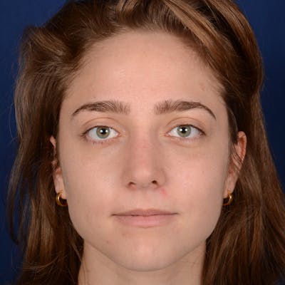 Female Rhinoplasty Before & After Gallery - Patient 196167 - Image 2