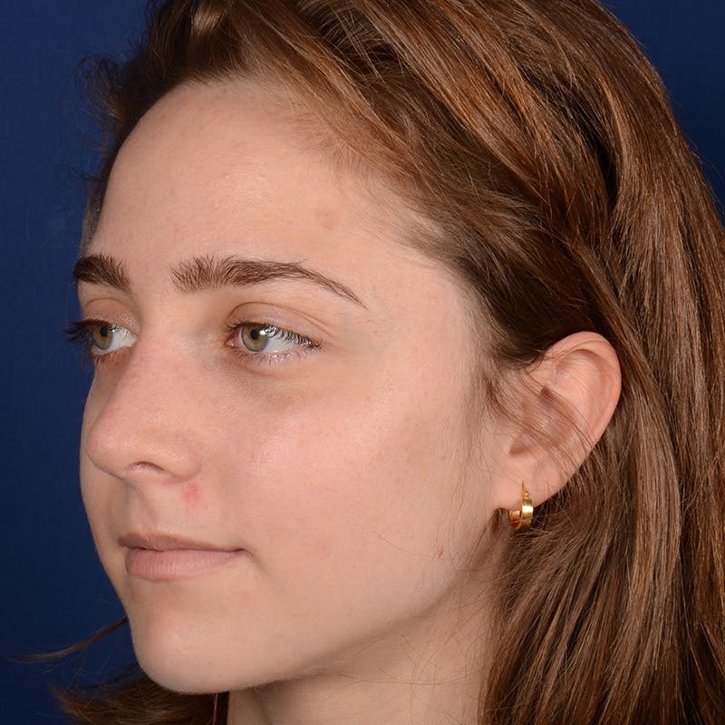 Female Rhinoplasty Before & After Gallery - Patient 196167 - Image 4