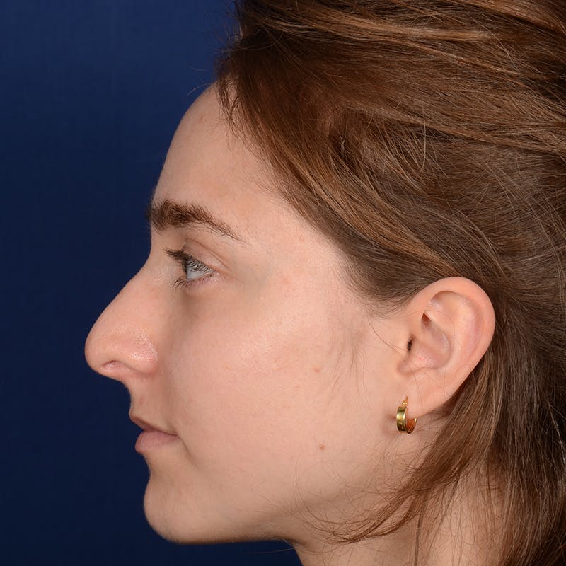 Female Rhinoplasty Before & After Gallery - Patient 196167 - Image 5