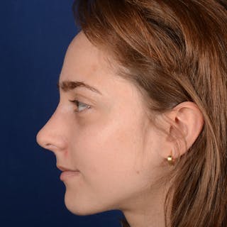 Female Rhinoplasty Before & After Gallery - Patient 196167 - Image 6