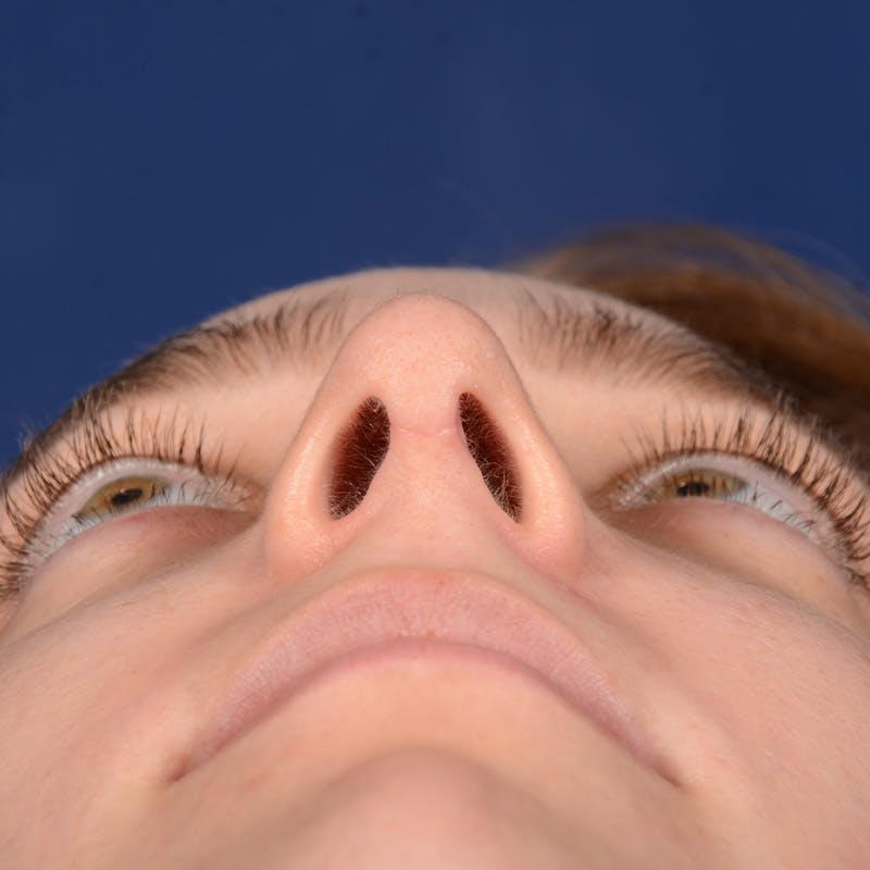 Female Rhinoplasty Before & After Gallery - Patient 196167 - Image 8