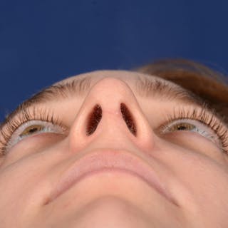 Female Rhinoplasty Before & After Gallery - Patient 196167 - Image 8