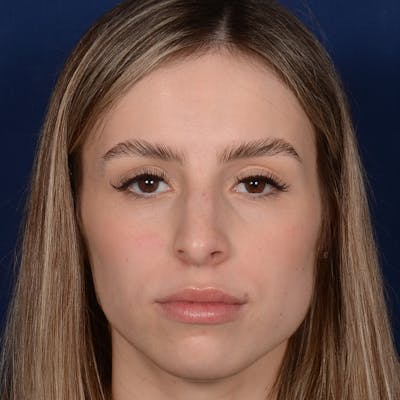Female Rhinoplasty Before & After Gallery - Patient 403054 - Image 1