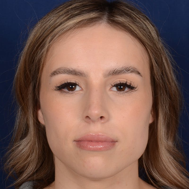 Female Rhinoplasty Before & After Gallery - Patient 403054 - Image 2