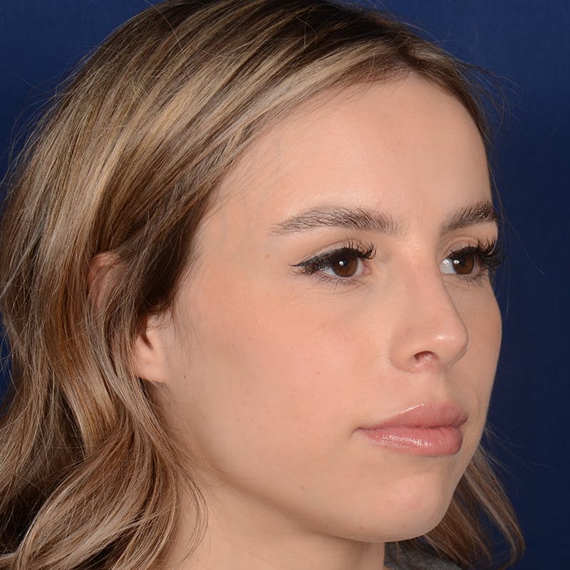 Female Rhinoplasty Before & After Gallery - Patient 403054 - Image 4