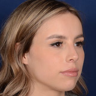 Female Rhinoplasty Before & After Gallery - Patient 403054 - Image 4