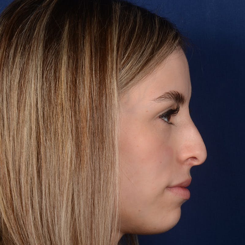 Female Rhinoplasty Before & After Gallery - Patient 403054 - Image 5