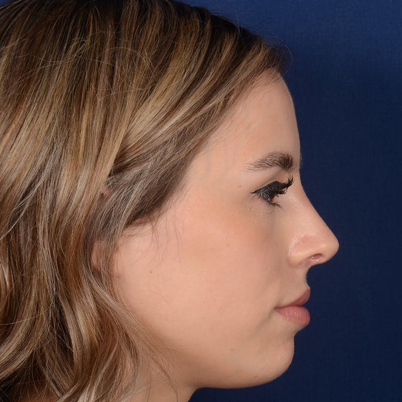 Female Rhinoplasty Before & After Gallery - Patient 403054 - Image 6