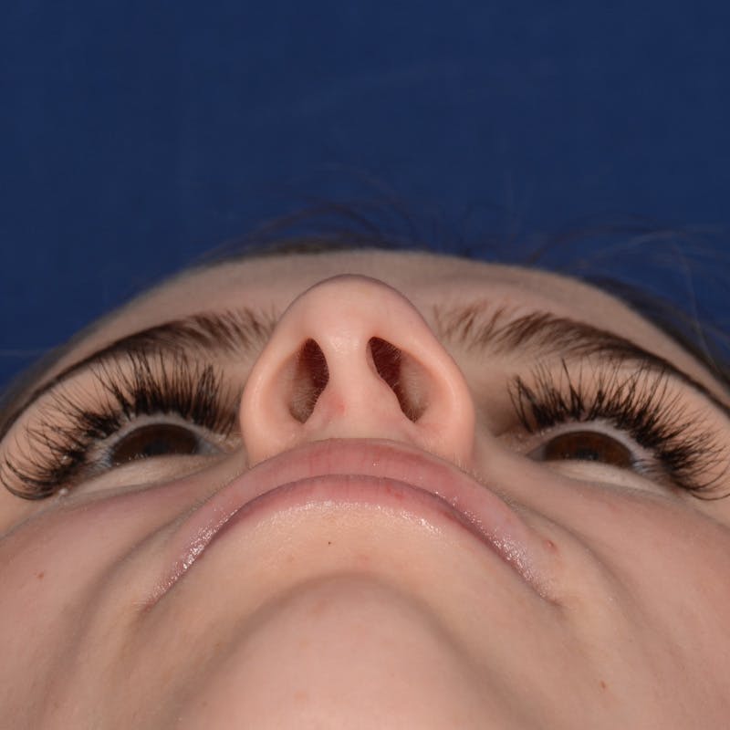 Female Rhinoplasty Before & After Gallery - Patient 403054 - Image 7