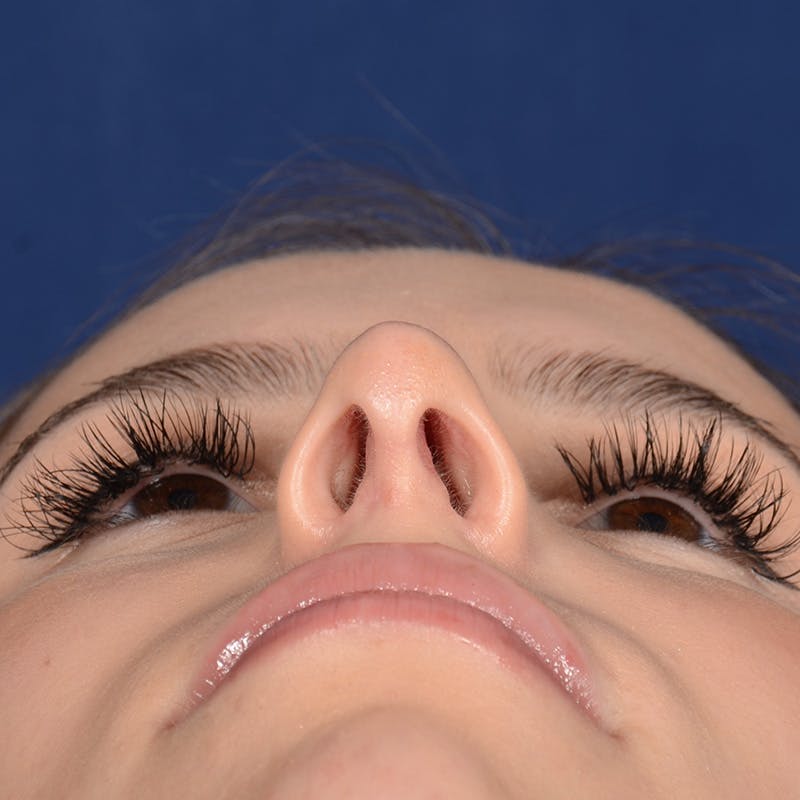 Female Rhinoplasty Before & After Gallery - Patient 403054 - Image 8