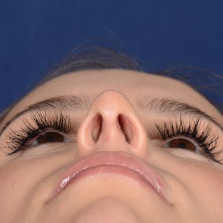 Female Rhinoplasty Before & After Gallery - Patient 403054 - Image 8