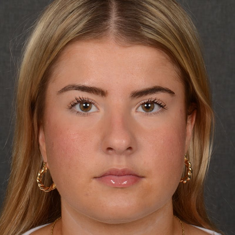 Female Rhinoplasty Before & After Gallery - Patient 518258 - Image 1