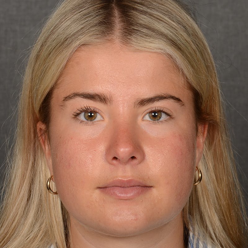 Female Rhinoplasty Before & After Gallery - Patient 518258 - Image 2