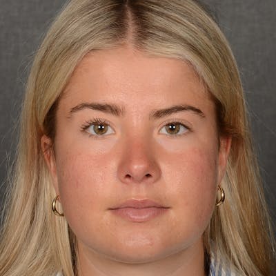 Female Rhinoplasty Before & After Gallery - Patient 518258 - Image 2