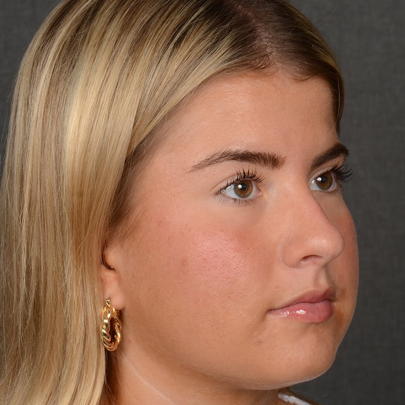 Female Rhinoplasty Before & After Gallery - Patient 518258 - Image 3