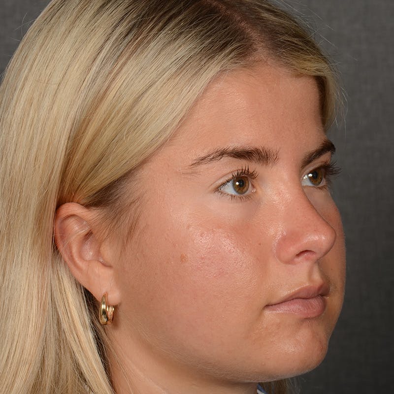 Female Rhinoplasty Before & After Gallery - Patient 518258 - Image 4