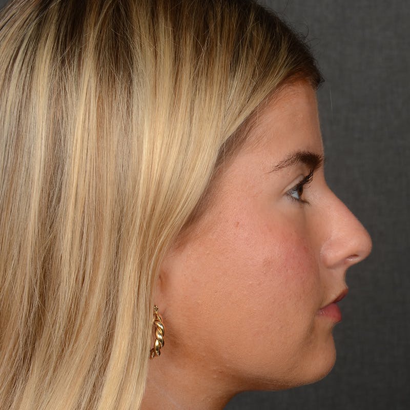 Female Rhinoplasty Before & After Gallery - Patient 518258 - Image 5