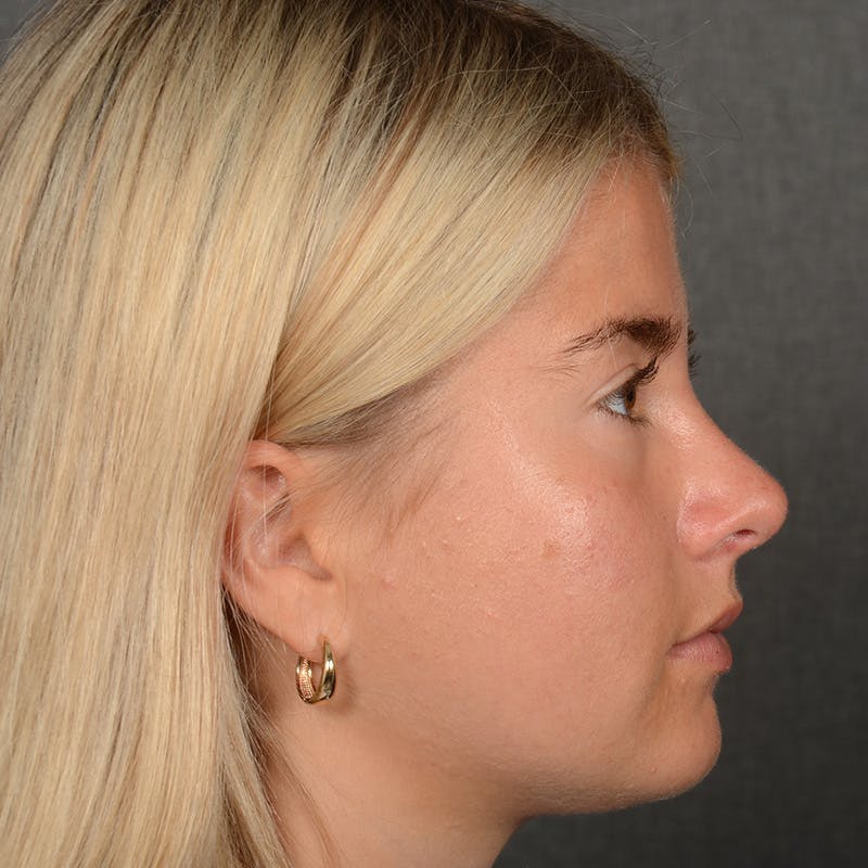 Female Rhinoplasty Before & After Gallery - Patient 518258 - Image 6