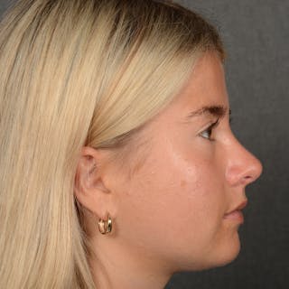 Female Rhinoplasty Before & After Gallery - Patient 518258 - Image 6