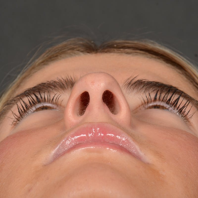 Female Rhinoplasty Before & After Gallery - Patient 518258 - Image 7