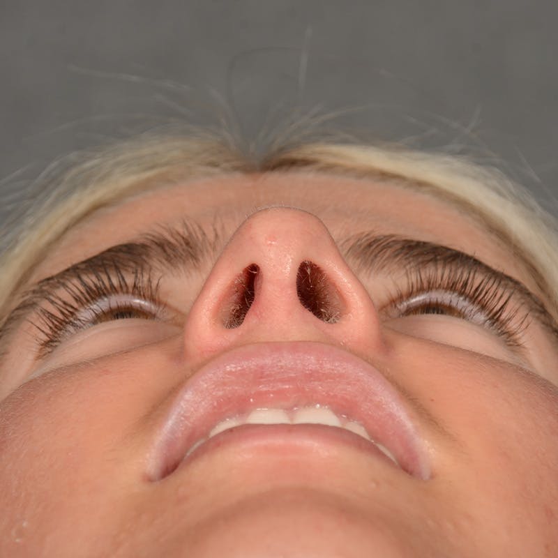 Female Rhinoplasty Before & After Gallery - Patient 518258 - Image 8