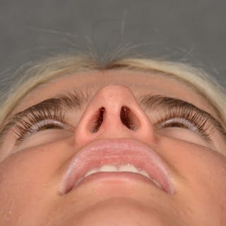 Female Rhinoplasty Before & After Gallery - Patient 518258 - Image 8