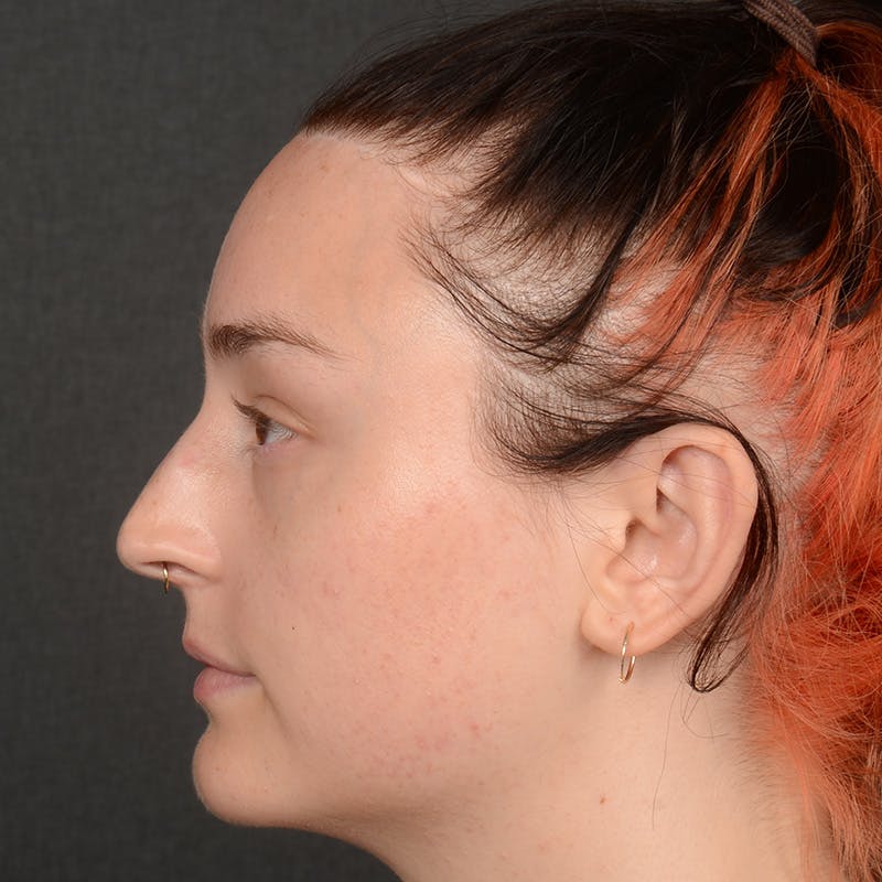 Female Rhinoplasty Before & After Gallery - Patient 939989 - Image 5