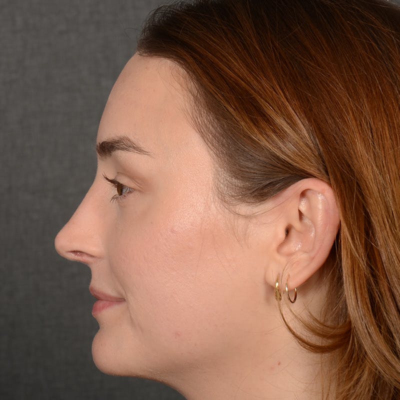 Female Rhinoplasty Before & After Gallery - Patient 939989 - Image 6