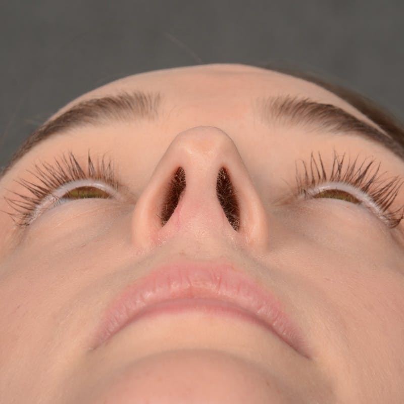 Female Rhinoplasty Before & After Gallery - Patient 939989 - Image 8
