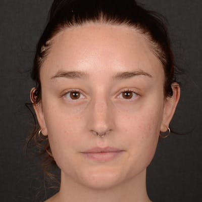 Female Rhinoplasty Before & After Gallery - Patient 939989 - Image 1