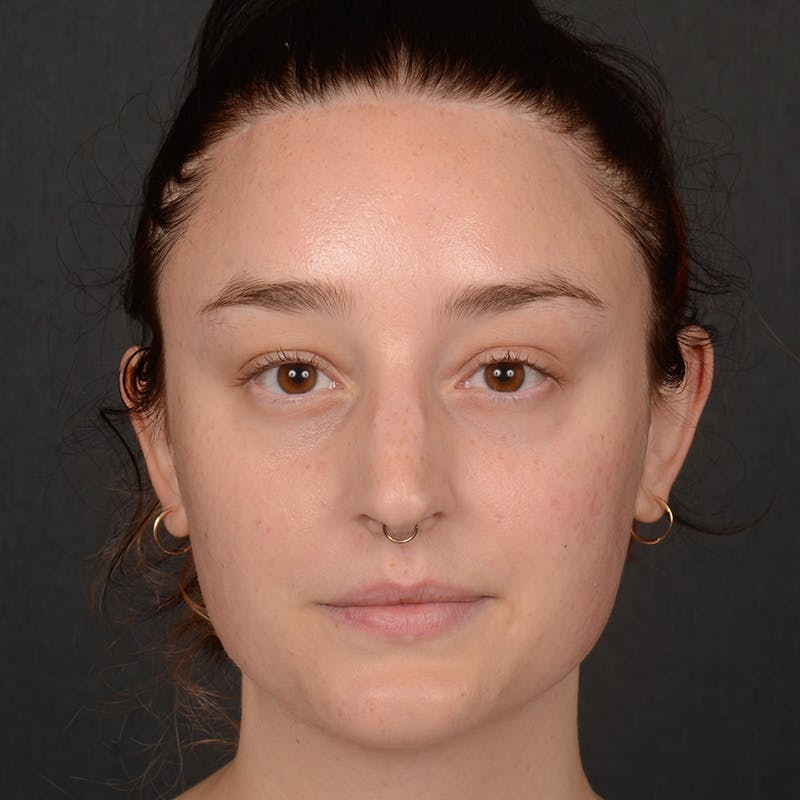 Female Rhinoplasty Before & After Gallery - Patient 939989 - Image 1