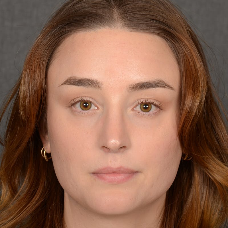 Female Rhinoplasty Before & After Gallery - Patient 939989 - Image 2