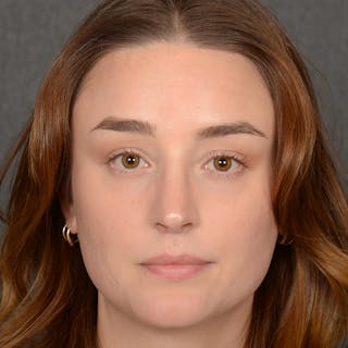 Female Rhinoplasty Before & After Gallery - Patient 939989 - Image 2