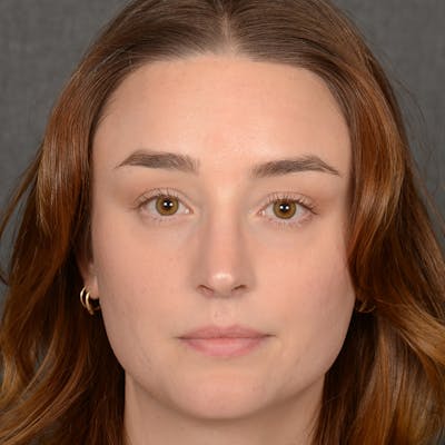 Female Rhinoplasty Before & After Gallery - Patient 939989 - Image 2