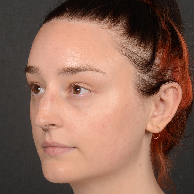 Female Rhinoplasty Before & After Gallery - Patient 939989 - Image 3