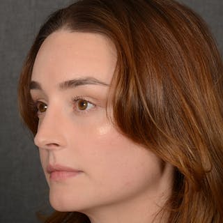 Female Rhinoplasty Before & After Gallery - Patient 939989 - Image 4