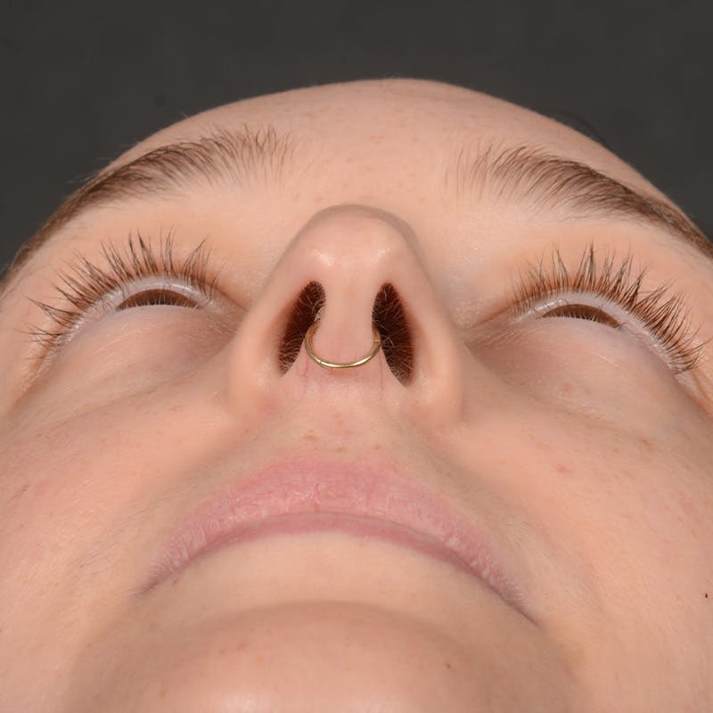 Female Rhinoplasty Before & After Gallery - Patient 939989 - Image 7