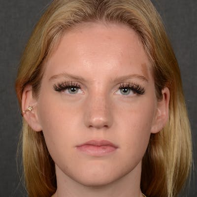 Female Rhinoplasty Before & After Gallery - Patient 248764 - Image 1