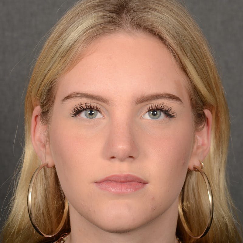 Female Rhinoplasty Before & After Gallery - Patient 248764 - Image 2